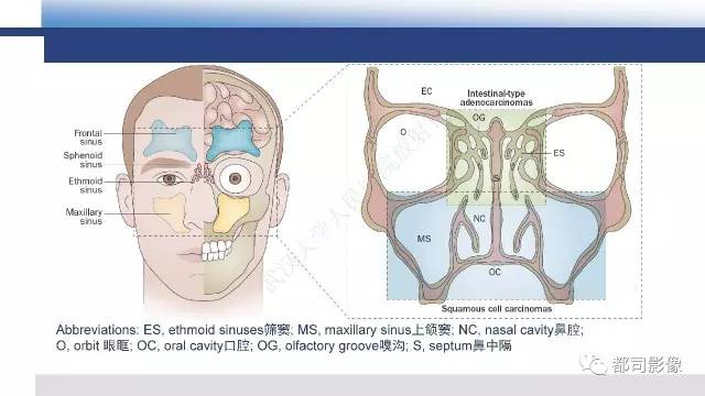 【PPT】鼻腔鼻窦孤立性纤维瘤影像诊断