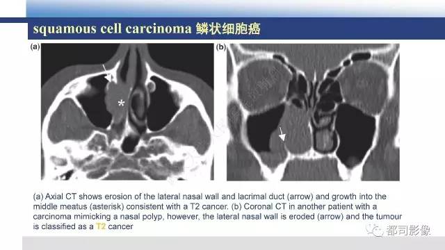 【PPT】鼻腔鼻窦孤立性纤维瘤影像诊断