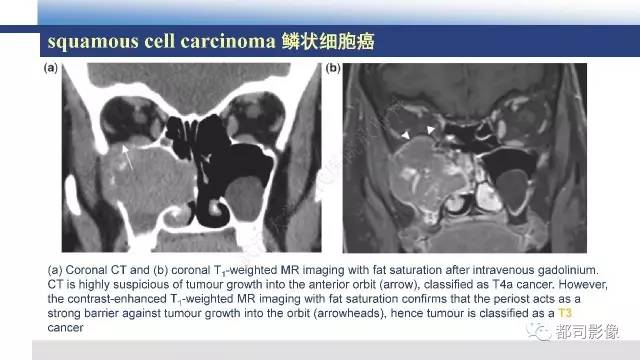 【PPT】鼻腔鼻窦孤立性纤维瘤影像诊断