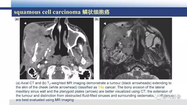 【PPT】鼻腔鼻窦孤立性纤维瘤影像诊断