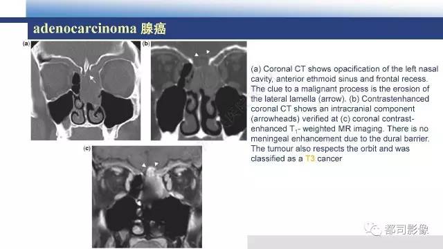 【PPT】鼻腔鼻窦孤立性纤维瘤影像诊断