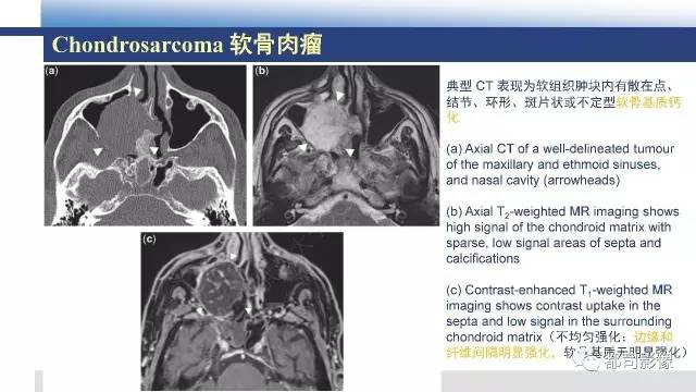 【PPT】鼻腔鼻窦孤立性纤维瘤影像诊断