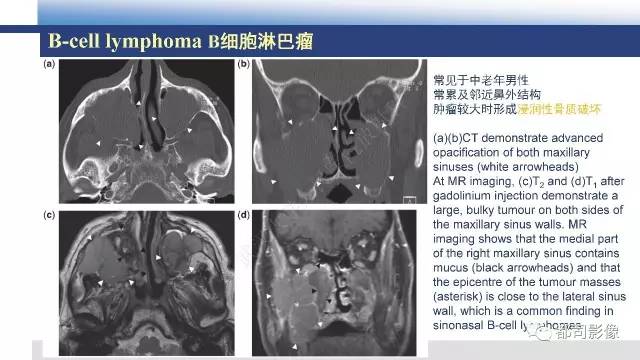 【PPT】鼻腔鼻窦孤立性纤维瘤影像诊断