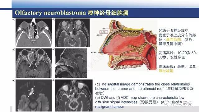 【PPT】鼻腔鼻窦孤立性纤维瘤影像诊断