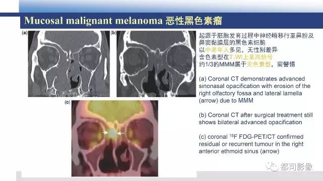 【PPT】鼻腔鼻窦孤立性纤维瘤影像诊断