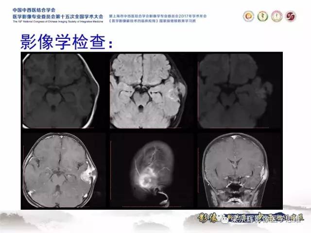 【病例】颅骨尤文氏肉瘤1例MR