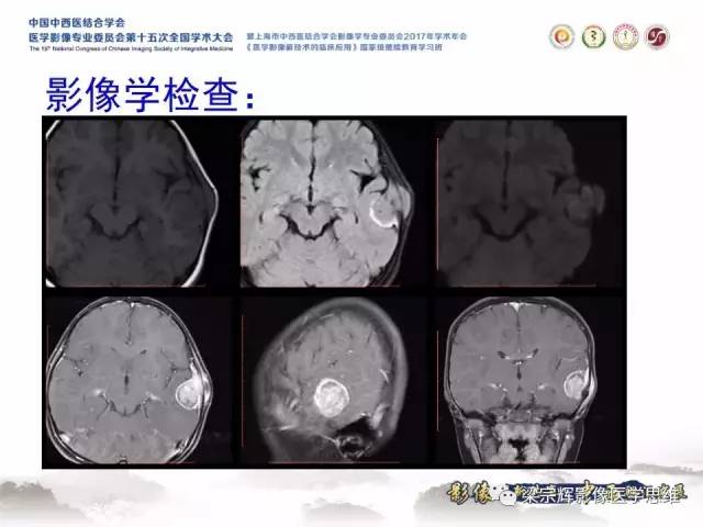 【病例】颅骨尤文氏肉瘤1例MR