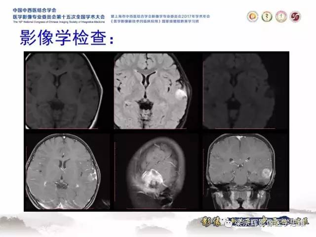 【病例】颅骨尤文氏肉瘤1例MR