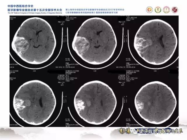 【病例】颅骨尤文氏肉瘤1例MR