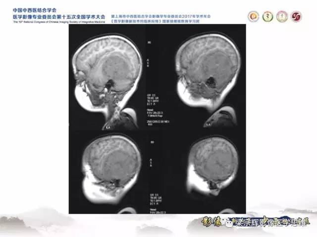 【病例】颅骨尤文氏肉瘤1例MR