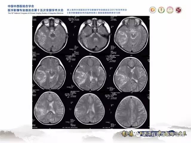 【病例】颅骨尤文氏肉瘤1例MR