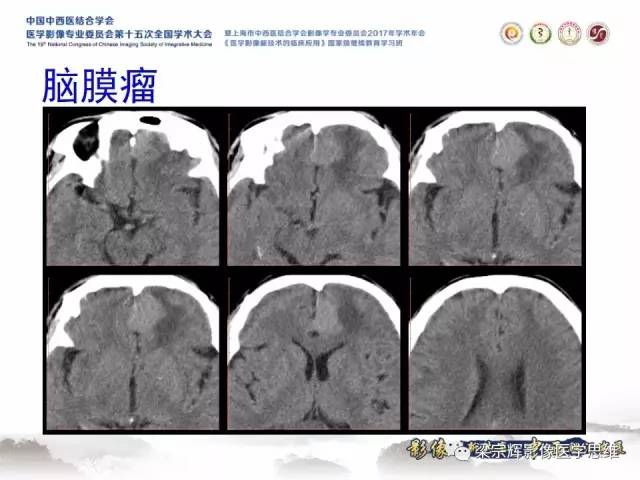 【病例】颅骨尤文氏肉瘤1例MR