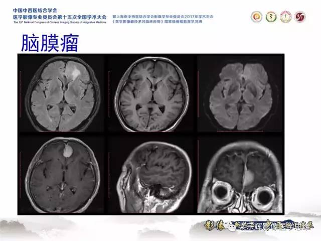 【病例】颅骨尤文氏肉瘤1例MR