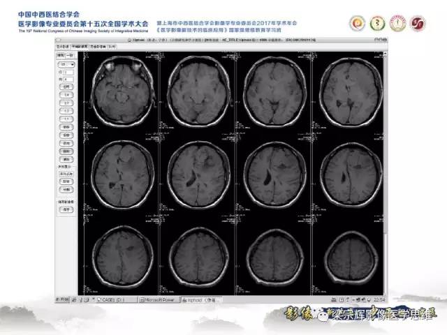 【病例】颅骨尤文氏肉瘤1例MR