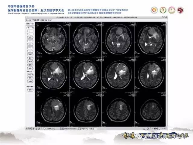 【病例】颅骨尤文氏肉瘤1例MR