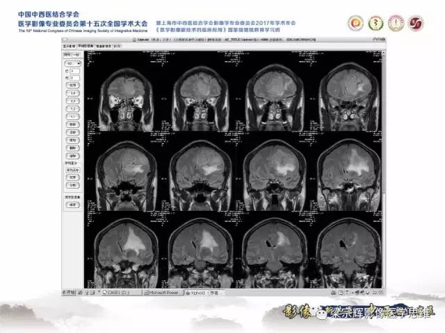 【病例】颅骨尤文氏肉瘤1例MR