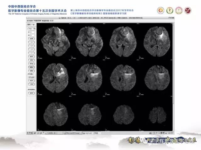 【病例】颅骨尤文氏肉瘤1例MR