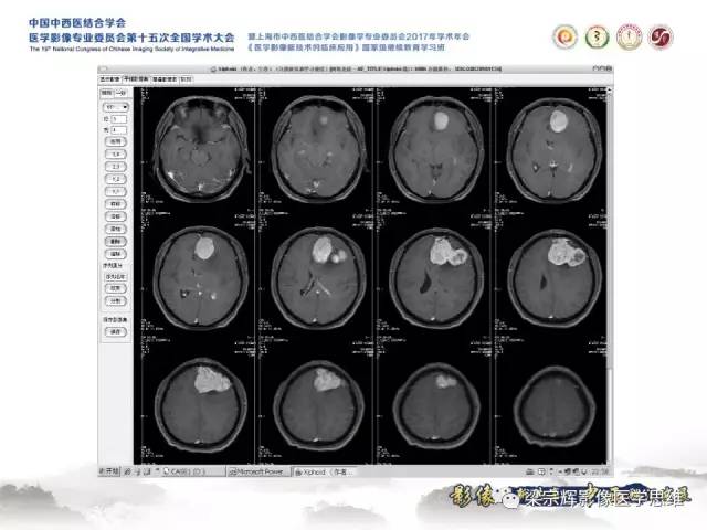 【病例】颅骨尤文氏肉瘤1例MR