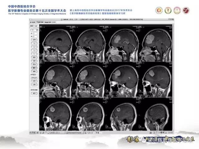 【病例】颅骨尤文氏肉瘤1例MR