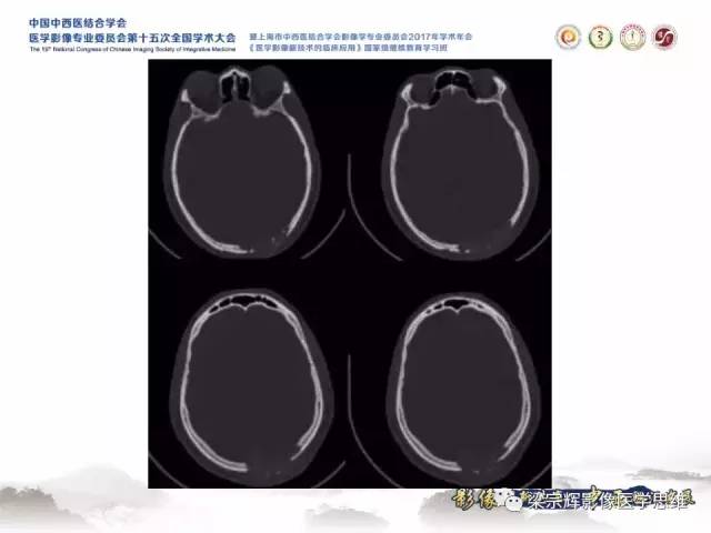 【病例】颅骨尤文氏肉瘤1例MR