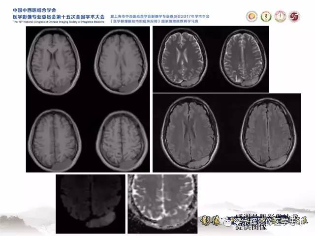 【病例】颅骨尤文氏肉瘤1例MR