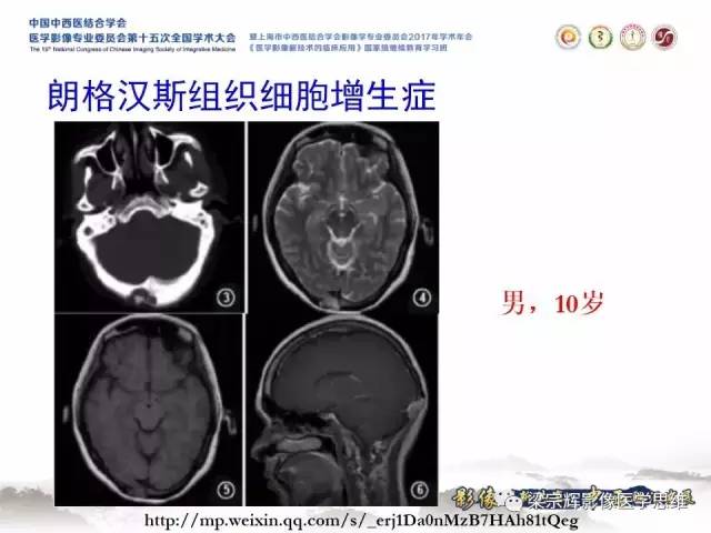 【病例】颅骨尤文氏肉瘤1例MR