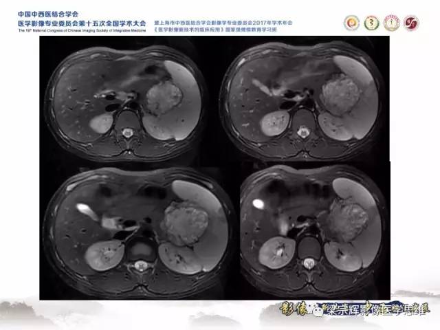 【病例】胰腺实性假乳头状瘤1例MR