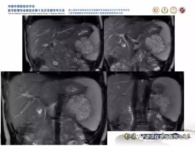 【病例】胰腺实性假乳头状瘤1例MR
