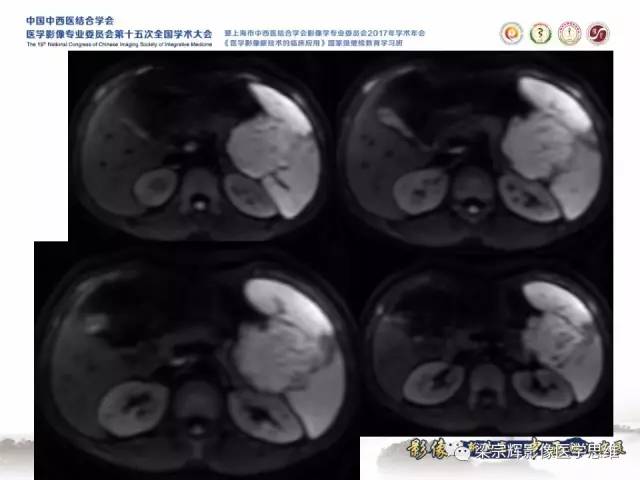 【病例】胰腺实性假乳头状瘤1例MR