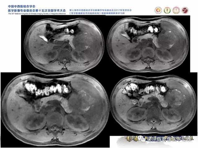 【病例】胰腺实性假乳头状瘤1例MR