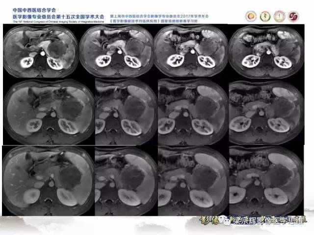 【病例】胰腺实性假乳头状瘤1例MR