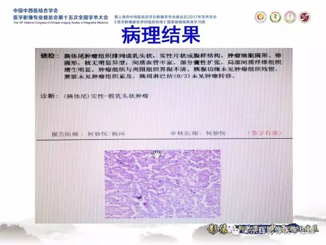 【病例】胰腺实性假乳头状瘤1例MR
