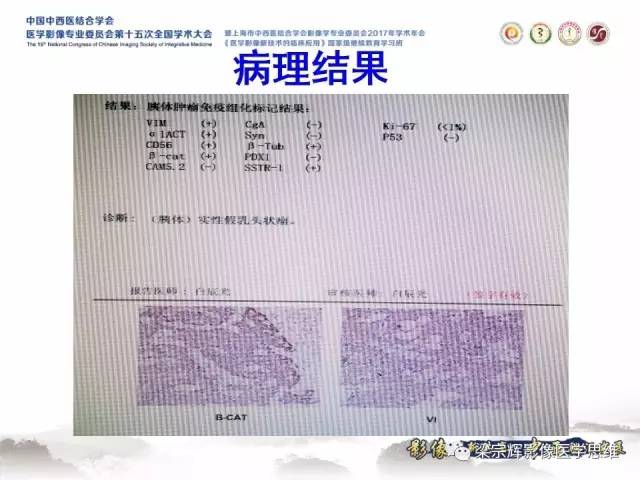 【病例】胰腺实性假乳头状瘤1例MR