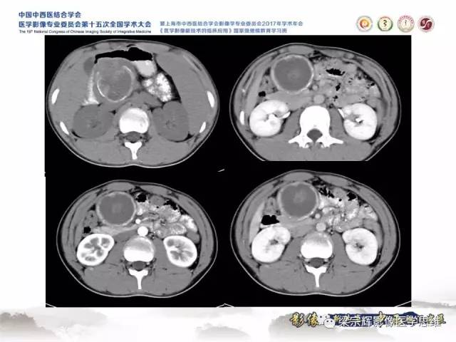 【病例】胰腺实性假乳头状瘤1例MR