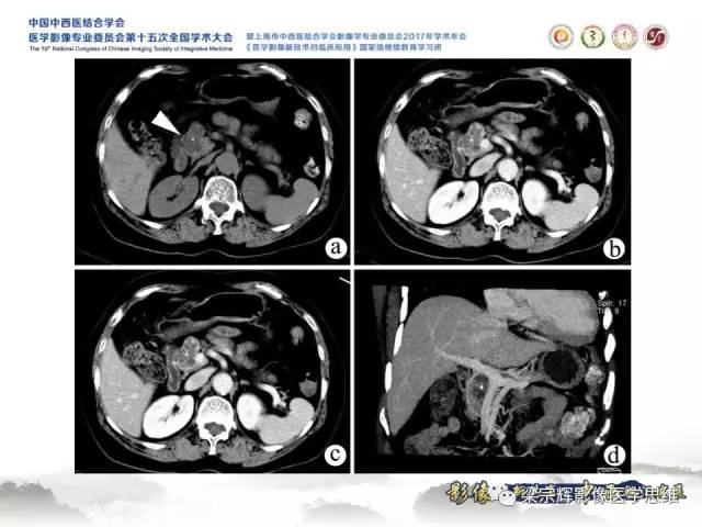 【病例】胰腺实性假乳头状瘤1例MR