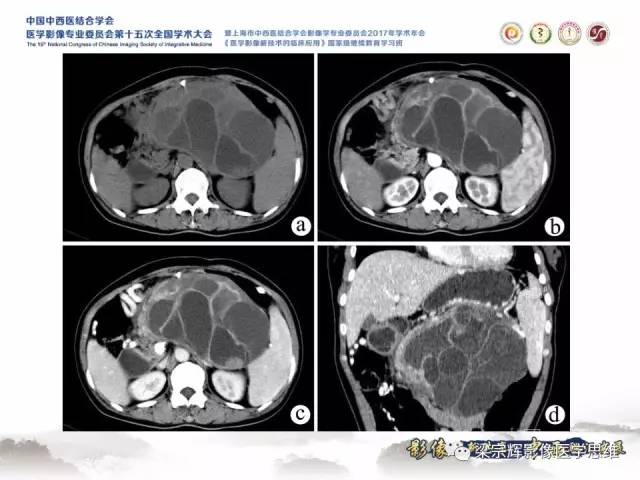 【病例】胰腺实性假乳头状瘤1例MR
