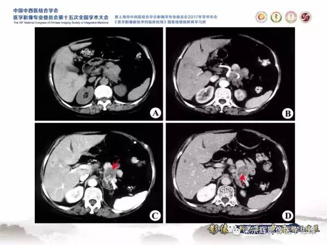 【病例】胰腺实性假乳头状瘤1例MR