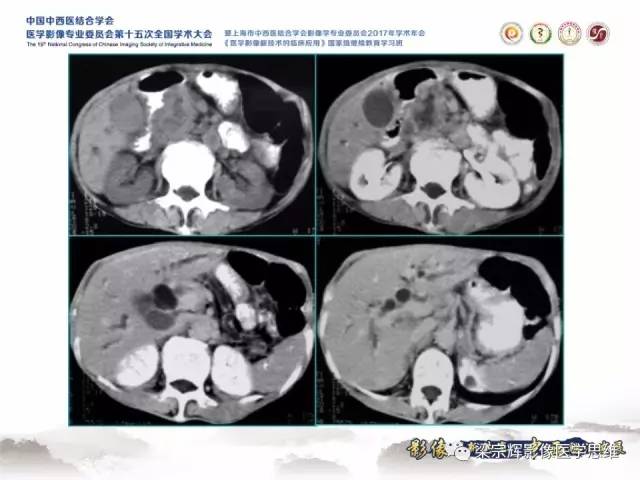 【病例】胰腺实性假乳头状瘤1例MR