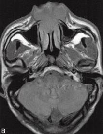 【病例】鼻腔动脉瘤样骨囊肿1例CT及MR