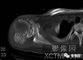 【病例】右肩关节滑膜骨软骨瘤病1例X线CT影像诊断分析
