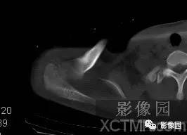 【病例】右肩关节滑膜骨软骨瘤病1例X线CT影像诊断分析 【病例】右肩关节滑膜骨软骨瘤病1例X线CT影像诊断分析