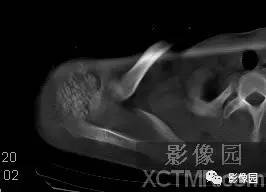 【病例】右肩关节滑膜骨软骨瘤病1例X线CT影像诊断分析 【病例】右肩关节滑膜骨软骨瘤病1例X线CT影像诊断分析