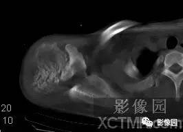 【病例】右肩关节滑膜骨软骨瘤病1例X线CT影像诊断分析 【病例】右肩关节滑膜骨软骨瘤病1例X线CT影像诊断分析