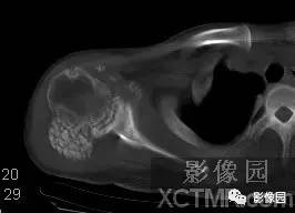 【病例】右肩关节滑膜骨软骨瘤病1例X线CT影像诊断分析 【病例】右肩关节滑膜骨软骨瘤病1例X线CT影像诊断分析