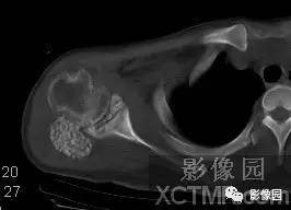 【病例】右肩关节滑膜骨软骨瘤病1例X线CT影像诊断分析 【病例】右肩关节滑膜骨软骨瘤病1例X线CT影像诊断分析