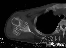 【病例】右肩关节滑膜骨软骨瘤病1例X线CT影像诊断分析 【病例】右肩关节滑膜骨软骨瘤病1例X线CT影像诊断分析