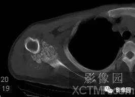 【病例】右肩关节滑膜骨软骨瘤病1例X线CT影像诊断分析 【病例】右肩关节滑膜骨软骨瘤病1例X线CT影像诊断分析