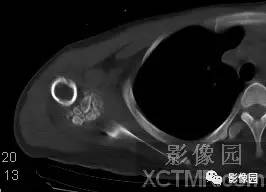 【病例】右肩关节滑膜骨软骨瘤病1例X线CT影像诊断分析 【病例】右肩关节滑膜骨软骨瘤病1例X线CT影像诊断分析