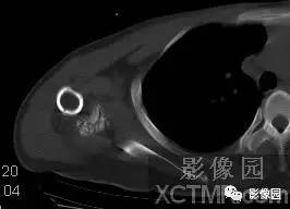 【病例】右肩关节滑膜骨软骨瘤病1例X线CT影像诊断分析 【病例】右肩关节滑膜骨软骨瘤病1例X线CT影像诊断分析