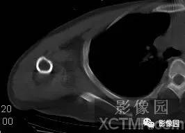【病例】右肩关节滑膜骨软骨瘤病1例X线CT影像诊断分析 【病例】右肩关节滑膜骨软骨瘤病1例X线CT影像诊断分析